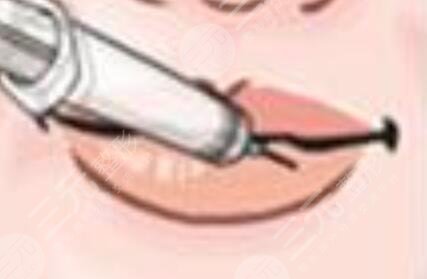 紋唇一到七天恢復(fù)過程參考：嘟嘟唇好看誘人~