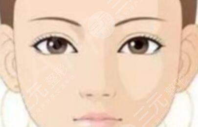 7mm雙眼皮術(shù)前