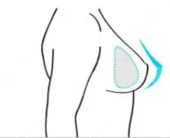 北京卡貝媞四季醫(yī)療美容診所假體隆胸案例