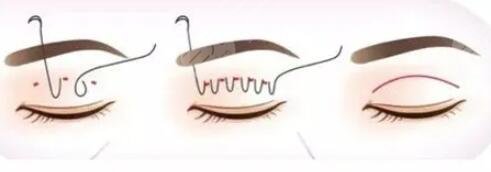 蘇大附一院整形美容科怎么樣，雙眼皮案例