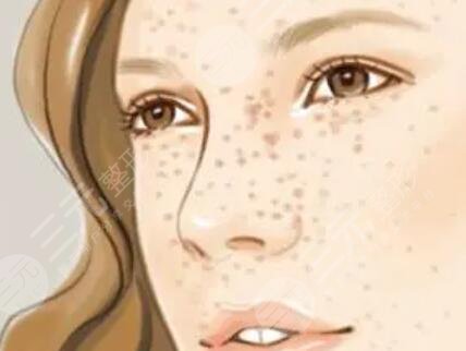 北京聚美匯成激光祛斑后3個(gè)月