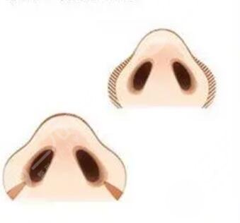 膨體隆鼻修復(fù)圖