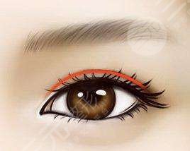 雙眼皮手術后22天