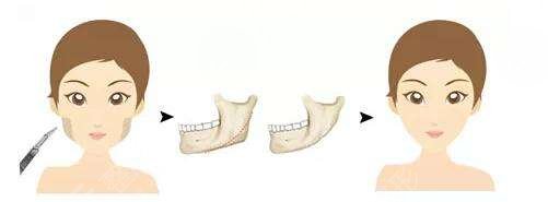 黃旭培在磨骨改臉型手術(shù)過程