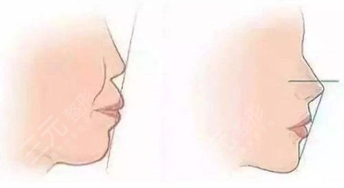 曹棟弼隆鼻圖片