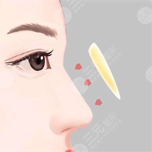 上海戴傳昌醫(yī)生隆鼻案例分享