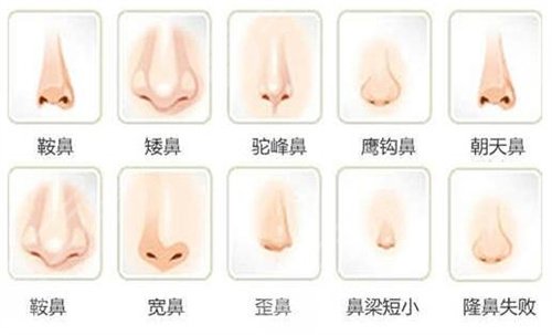 廣州隆鼻案例分享