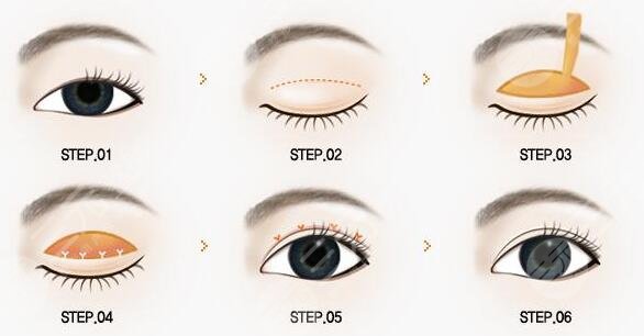 深圳陳芝眼修復(fù)術(shù)前