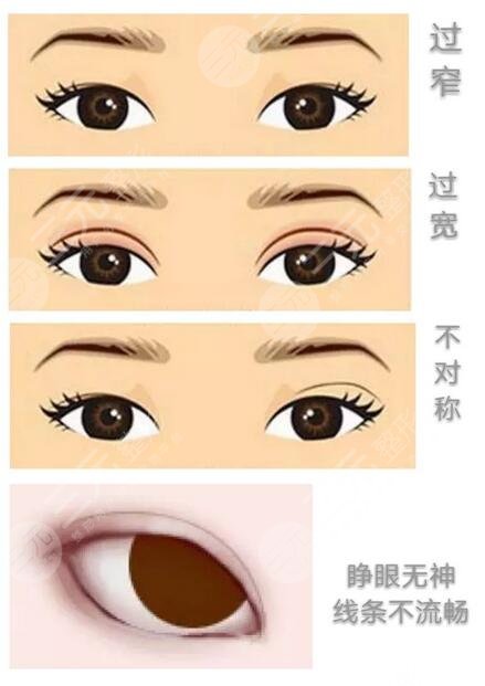 深圳陳芝眼修復(fù)術(shù)后一個(gè)月