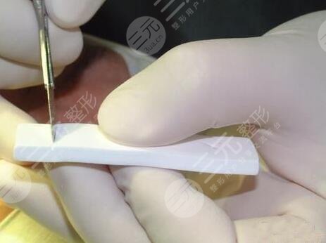 付榮峰做鼻子怎么樣？做鼻子案例搶先看！