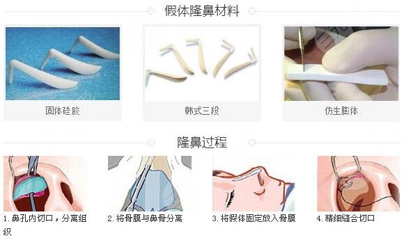 羅匯東做鼻子案例果術后30天