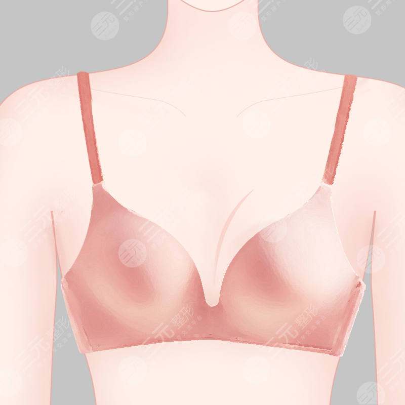 上海九院隆胸案例圖術(shù)前