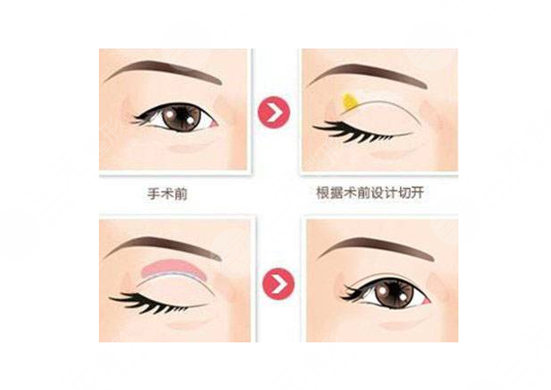 蘭大二院整形科價(jià)格表2021新版，醫(yī)生簡介|雙眼皮修復(fù)案例