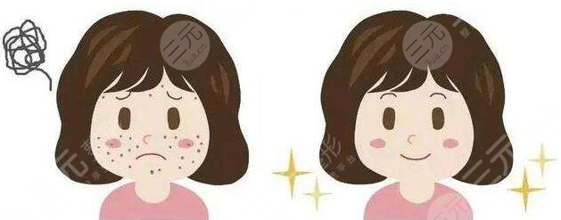 濟寧人民醫(yī)院激光祛痘祛疤圖