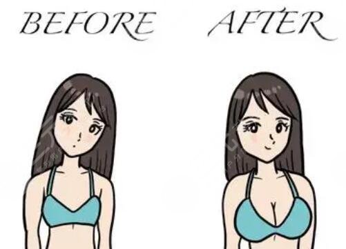 毛面假體和光面假體哪個好？隆胸假體型號分析_假體隆胸術前術后注意事項