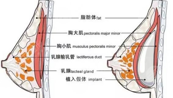 硅膠隆胸手術有危害嗎?