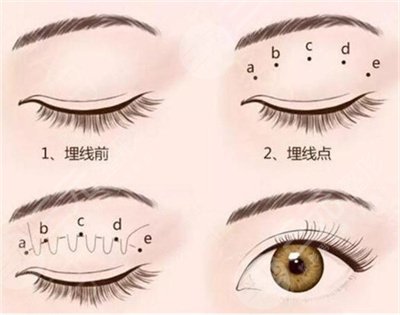 八大處雙眼皮價(jià)格表