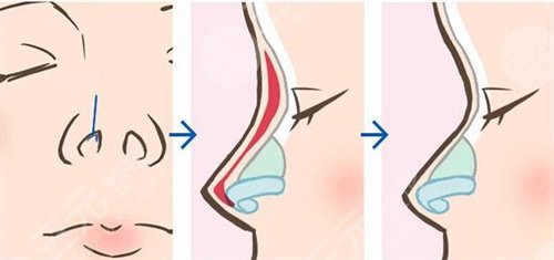 鼻翼縮小手術案例