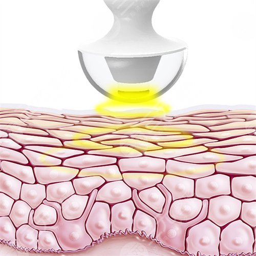 光子嫩膚后的一些注意事項