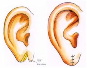 顱耳角在30°-60°之間矯正術(shù)后注意事項