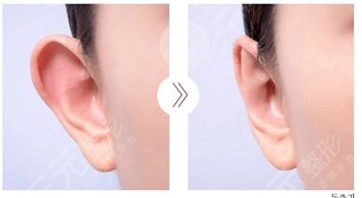 什么是顱耳角在30°-60°之間