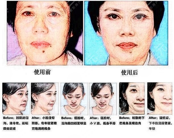 玻尿酸填充法令紋真實案例果圖：術前一天