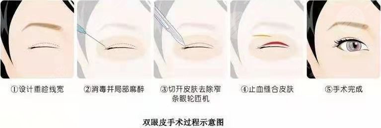 易陽艷割雙眼皮手術(shù)過程