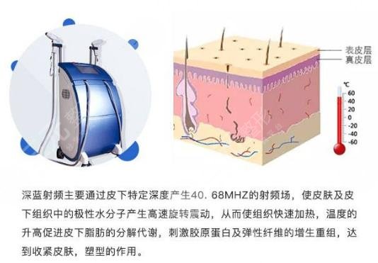 深藍(lán)射頻做一次有果嗎?