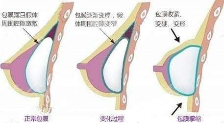 假體隆胸的注意事宜有哪些？