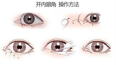 開眼角前后對比圖 原理