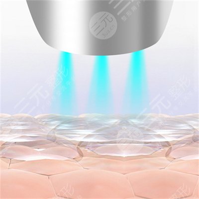 激光嫩膚一般多少錢?真實果圖