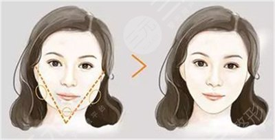 下頜角磨骨案例術(shù)前