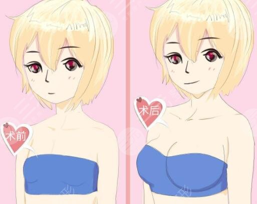 胸假體優(yōu)勢上的差別