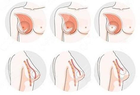 假體隆胸有禁忌嗎?