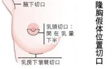 假體隆胸手術適合哪些人呢?