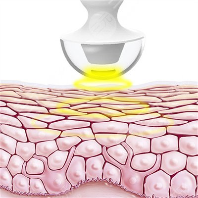 熱瑪吉改良的眼部問題有哪些?