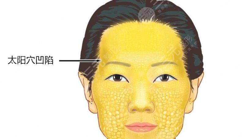 自體脂肪填充太陽穴