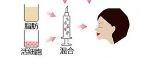 自體脂肪填充太陽穴