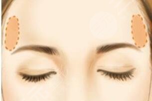 自體脂肪填充太陽穴