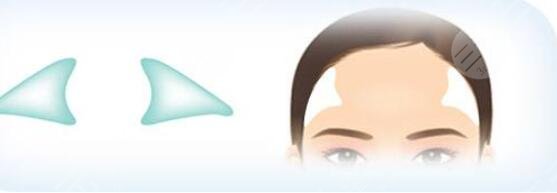 自體脂肪填充太陽穴