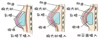 假體隆胸恢復(fù)果圖片分享，記錄術(shù)后每一天的變化~