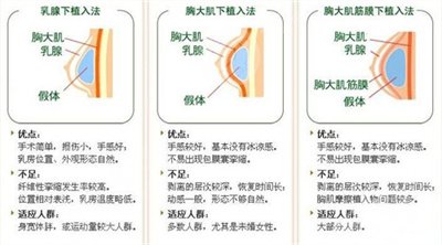 假體隆胸恢復(fù)果圖片分享，記錄術(shù)后每一天的變化~