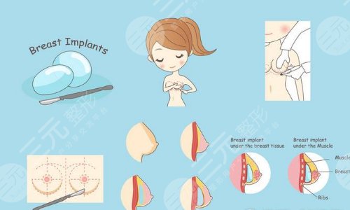 棉花糖隆胸手術(shù)原理