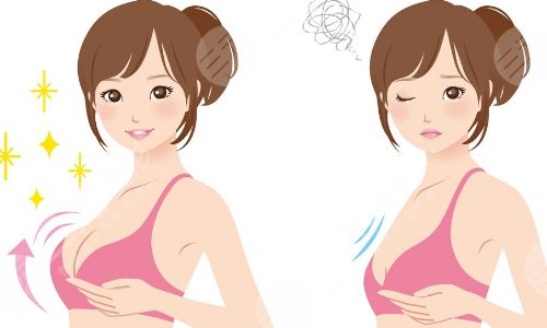 棉花糖隆胸真的可以預(yù)防包膜攣縮嗎?