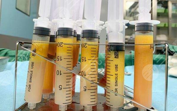 脂肪膠和自體脂肪區(qū)