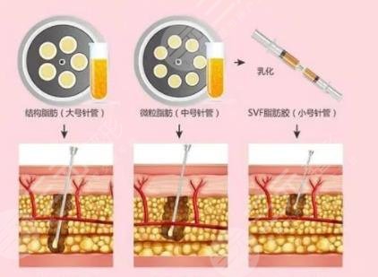 脂肪膠和自體脂肪區(qū)