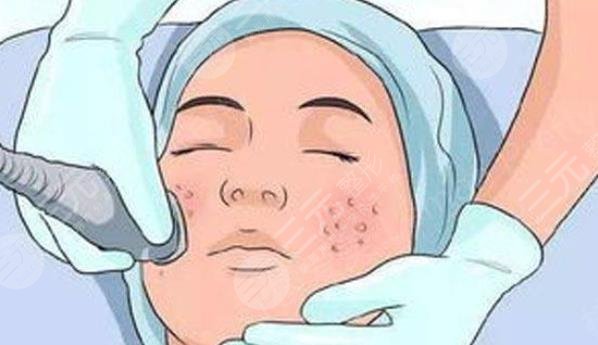 超激光美膚激光美白