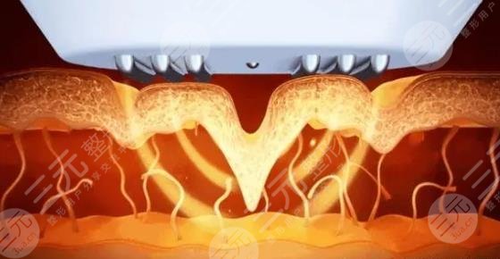 超激光美膚激光美白