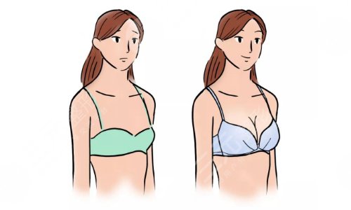 棉花糖隆胸的優(yōu)勢(shì)有哪些?