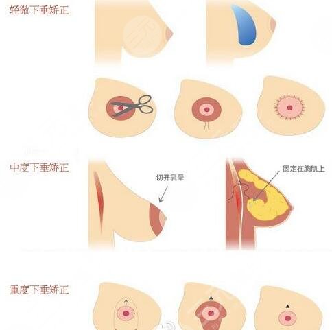 棉花糖隆胸真的不疼嗎？